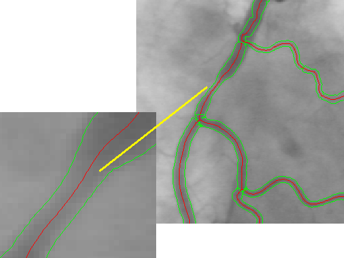 support vascular diagnostics by subpixel-accurate measurements enhancing the spatial resolution.